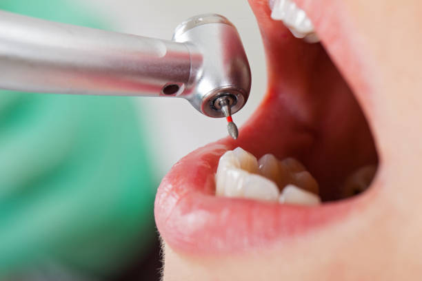 Best Emergency Dental Extractions in Hamilton College, NY